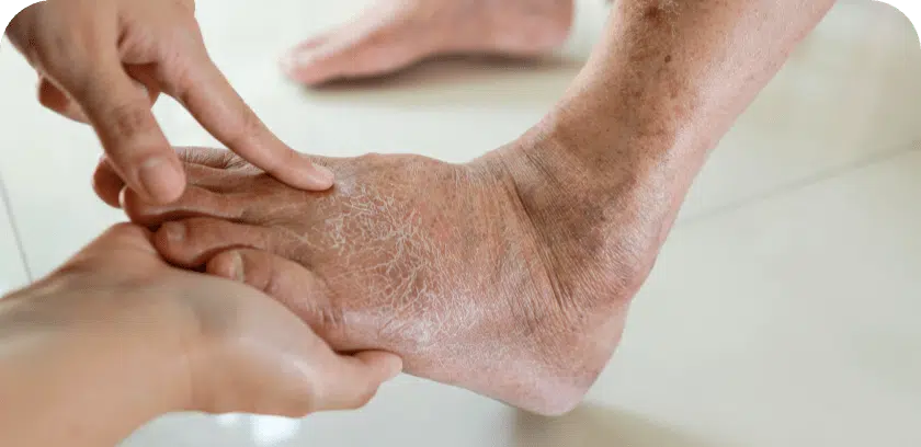 Change in skin appearance in feet