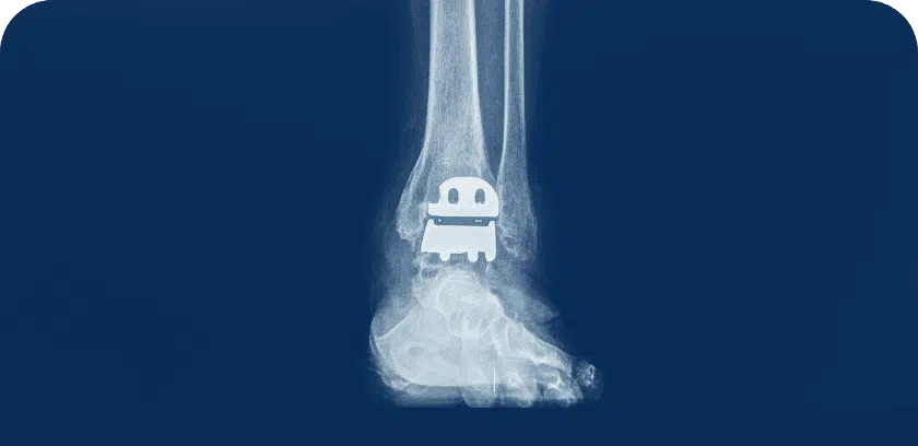 Total Ankle Replacement Surgery options