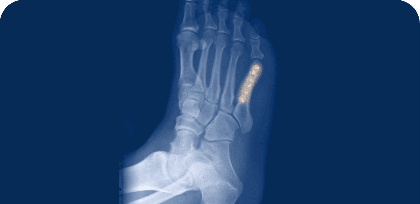 Midfoot Fusion treatment options with The Relief Institute
