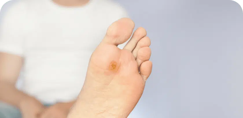 diabetic foot wound treatments and conditions
