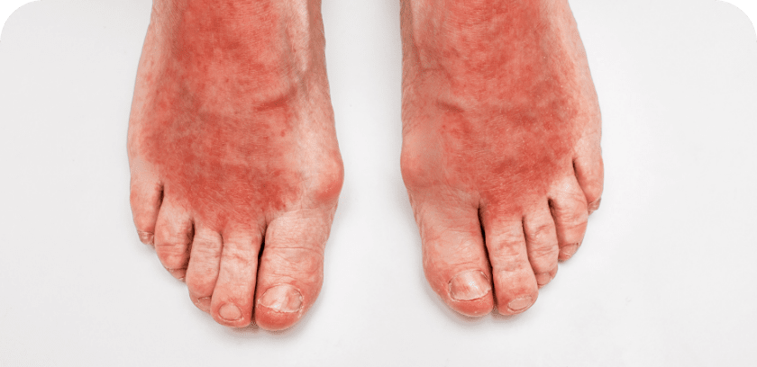 thermal injuries on feet treatment options