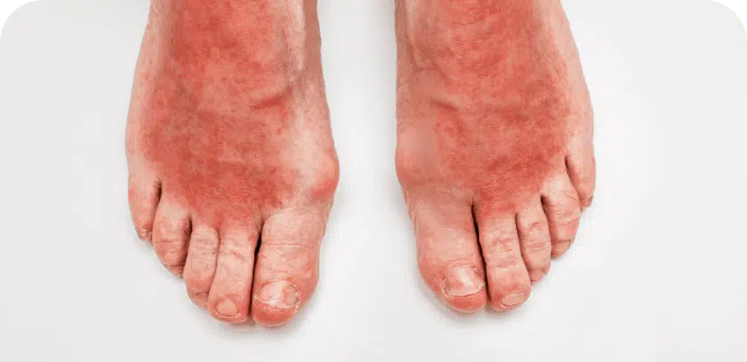 thermal injuries on feet treatment options