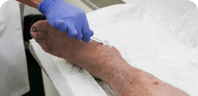Wound Debridement treatment options with The Relief Institute